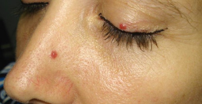 Tẩy nốt ruồi bằng laser, phương pháp phẫu thuật, tại nhà. Hậu quả, vết thương bao lâu lành, sẹo