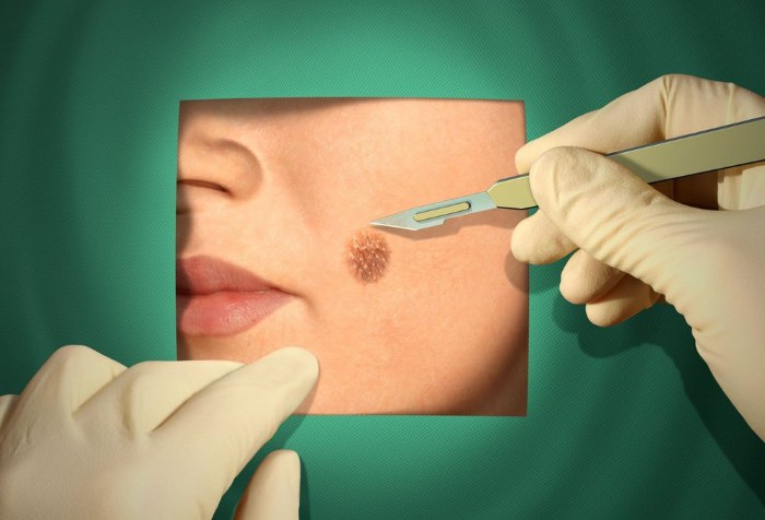 Tẩy nốt ruồi bằng laser, phương pháp phẫu thuật, tại nhà. Hậu quả, vết thương bao lâu lành, sẹo