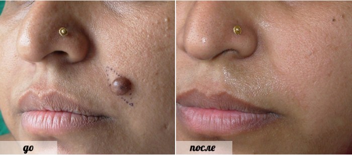Tẩy nốt ruồi bằng laser, phương pháp phẫu thuật, tại nhà. Hậu quả, vết thương bao lâu lành, sẹo
