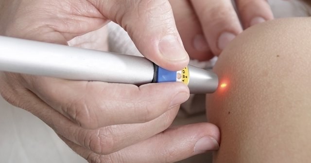 Tẩy nốt ruồi bằng laser, phương pháp phẫu thuật, tại nhà. Hậu quả, vết thương bao lâu lành, sẹo