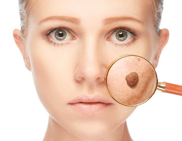 Tẩy nốt ruồi bằng laser, phương pháp phẫu thuật, tại nhà. Hậu quả, vết thương bao lâu lành, sẹo