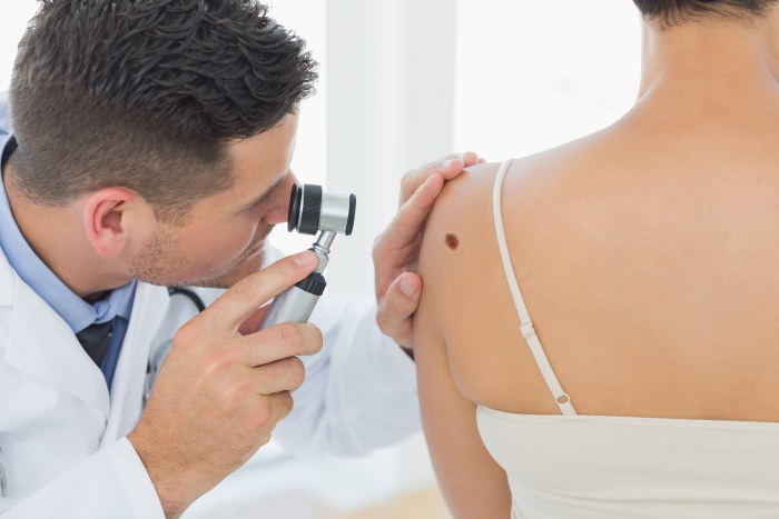 Tẩy nốt ruồi bằng laser, phương pháp phẫu thuật, tại nhà. Hậu quả, vết thương bao lâu lành, sẹo
