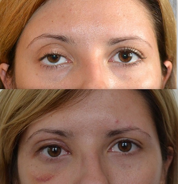 Botox cho mặt là gì, tiêm, tiêm nano botox ở trán, nếp gấp rãnh mũi má, nách