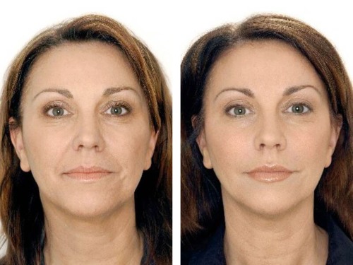 Botox cho mặt là gì, tiêm, tiêm nano botox ở trán, nếp gấp rãnh mũi má, nách