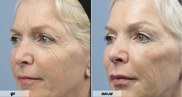 Botox cho mặt là gì, tiêm, tiêm nano botox ở trán, nếp gấp rãnh mũi má, nách