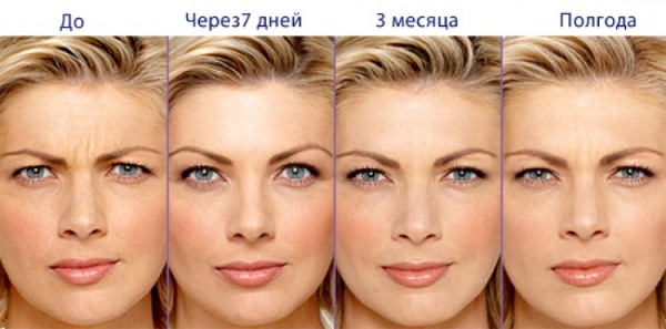 Botox cho mặt là gì, tiêm, tiêm nano botox ở trán, nếp gấp rãnh mũi má, nách