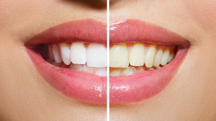 Como clarear os dentes em casa sem agredir o esmalte rapidamente por causa do amarelecimento. Produtos e receitas populares