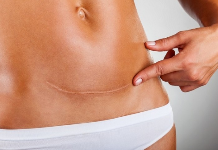 Parut keloid selepas pembedahan - apa itu dan mengapa ia berbahaya? Apa rupa parut keloid. Gambar