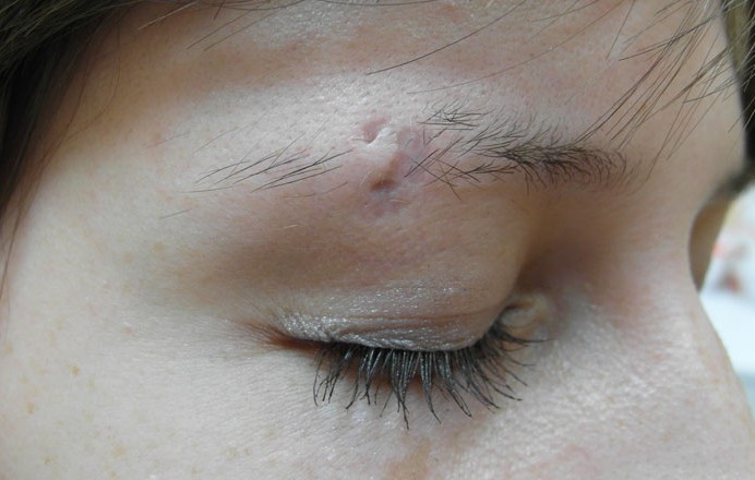 Parut keloid selepas pembedahan - apa itu dan mengapa ia berbahaya? Apa rupa parut keloid. Gambar