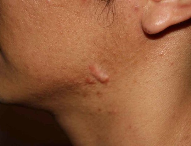 Parut keloid selepas pembedahan - apa itu dan mengapa ia berbahaya? Apa rupa parut keloid. Gambar