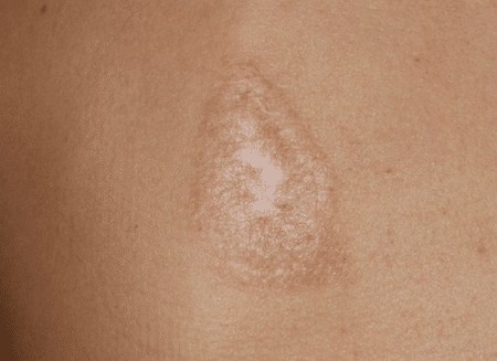 Parut keloid selepas pembedahan - apa itu dan mengapa ia berbahaya? Apa rupa parut keloid. Gambar