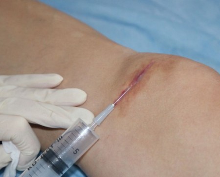 Parut keloid selepas pembedahan - apa itu dan mengapa ia berbahaya? Apa rupa parut keloid. Gambar