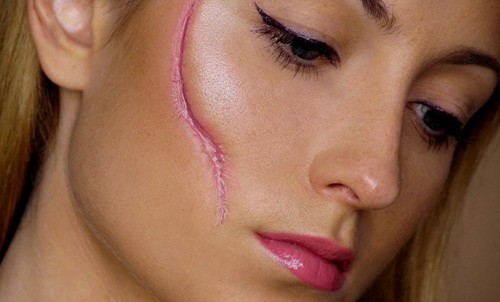 Parut keloid selepas pembedahan - apa itu dan mengapa ia berbahaya? Apa rupa parut keloid. Gambar
