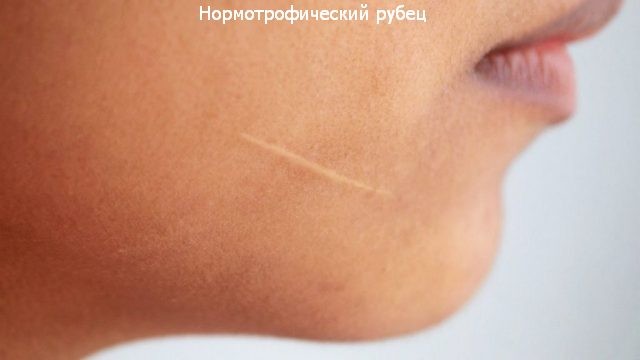 Parut keloid selepas pembedahan - apa itu dan mengapa ia berbahaya? Apa rupa parut keloid. Gambar