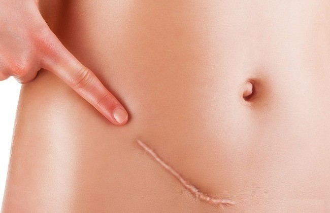 Parut keloid selepas pembedahan - apa itu dan mengapa ia berbahaya? Apa rupa parut keloid. Gambar
