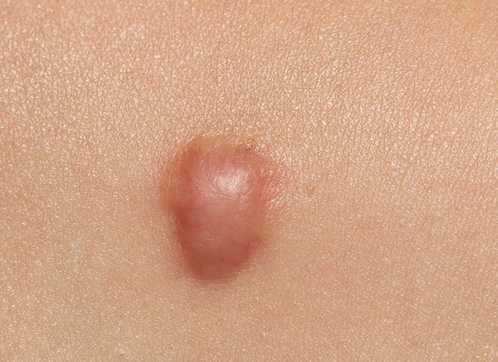 Parut keloid selepas pembedahan - apa itu dan mengapa ia berbahaya? Apa rupa parut keloid. Gambar