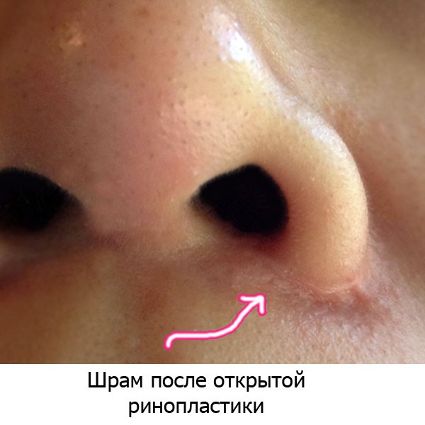 Parut keloid selepas pembedahan - apa itu dan mengapa ia berbahaya? Apa rupa parut keloid. Gambar