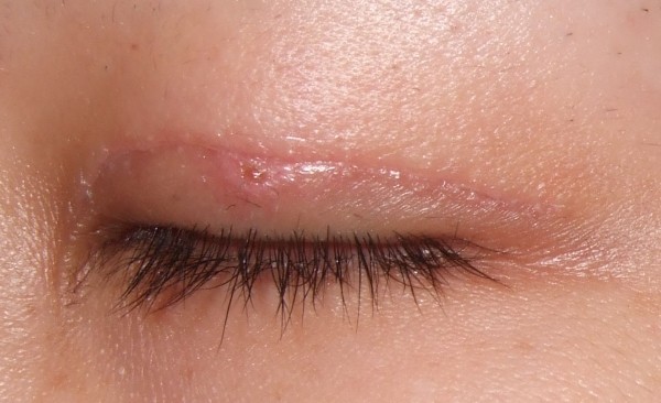 Parut keloid selepas pembedahan - apa itu dan mengapa ia berbahaya? Apa rupa parut keloid. Gambar