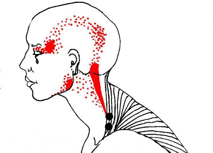 Urut Myofascial - apa itu, belajar mengurut wajah, badan, belakang. Foto, pelajaran video oleh Shubina