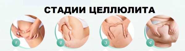 Massage chống cellulite tại nhà. Cách làm để giảm béo bụng, chân, mông và các bộ phận khác trên cơ thể. Hướng dẫn từng bước với ảnh