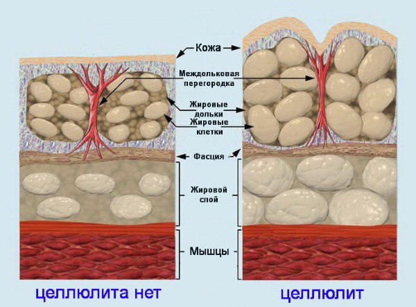 Massage chống cellulite tại nhà. Cách làm để giảm béo bụng, chân, mông và các bộ phận khác trên cơ thể. Hướng dẫn từng bước với ảnh