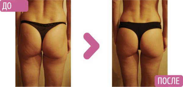 Massage chống cellulite tại nhà. Cách làm để giảm béo bụng, chân, mông và các bộ phận khác trên cơ thể. Hướng dẫn từng bước với ảnh