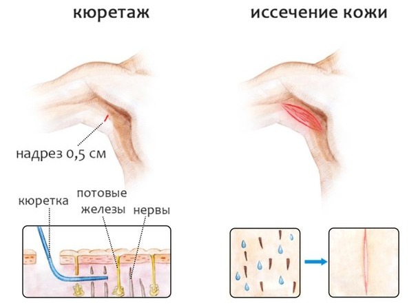Nguyên nhân và cách điều trị chứng ra mồ hôi nách nhiều ở phụ nữ. Làm thế nào để loại bỏ mồ hôi bằng các biện pháp dân gian