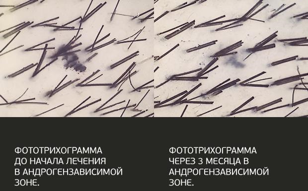 Ампуле за косу Еуцапил - састав, упутства за употребу, резултати употребе код жена и мушкараца. Цена, прегледи и где купити производ