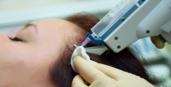 الميزوثيرابي للشعر - ما هو في التجميل ، كيف يتم ذلك ، ما هي الأدوية المستخدمة. الصور والاستعراضات