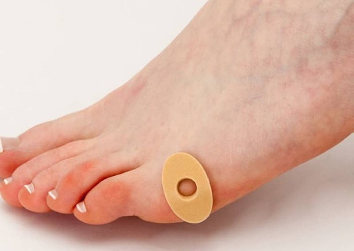 Vết chai ở chân - cách điều trị tại nhà bằng các biện pháp dân gian, thuốc mỡ, kem bôi, thạch cao