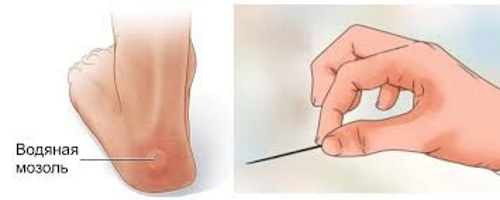 Vết chai ở chân - cách điều trị tại nhà bằng các biện pháp dân gian, thuốc mỡ, kem bôi, thạch cao