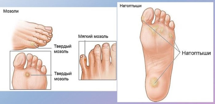 Vết chai ở chân - cách điều trị tại nhà bằng các biện pháp dân gian, thuốc mỡ, kem bôi, thạch cao