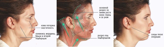 Oval facelift - mengangkat, krim kulit, benang, topeng, latihan di rumah. Gambar