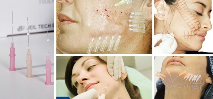 Oval facelift - mengangkat, krim kulit, benang, topeng, latihan di rumah. Gambar