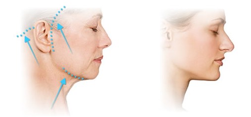 Oval facelift - mengangkat, krim kulit, benang, topeng, latihan di rumah. Gambar
