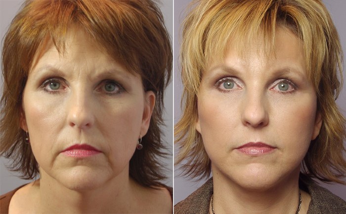Oval facelift - mengangkat, krim kulit, benang, topeng, latihan di rumah. Gambar