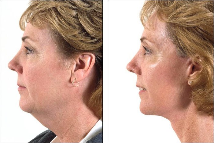 Oval facelift - mengangkat, krim kulit, benang, topeng, latihan di rumah. Gambar