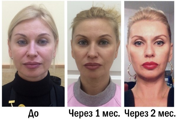 Oval facelift - mengangkat, krim kulit, benang, topeng, latihan di rumah. Gambar