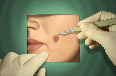 Trên cơ thể và mặt có nốt ruồi. Lý do xuất hiện, loại nguy hiểm và không nguy hiểm, ảnh, cách loại bỏ và liệu có thể