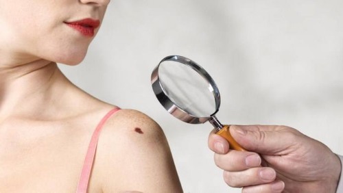 Trên cơ thể và mặt có nốt ruồi. Lý do xuất hiện, loại nguy hiểm và không nguy hiểm, ảnh, cách loại bỏ và liệu có thể