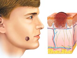 Trên cơ thể và mặt có nốt ruồi. Lý do xuất hiện, loại nguy hiểm và không nguy hiểm, ảnh, cách loại bỏ và liệu có thể