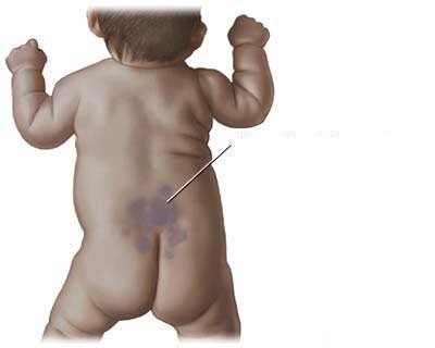 Trên cơ thể và mặt có nốt ruồi. Lý do xuất hiện, loại nguy hiểm và không nguy hiểm, ảnh, cách loại bỏ và liệu có thể