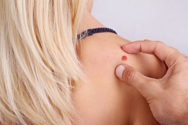 Trên cơ thể và mặt có nốt ruồi. Lý do xuất hiện, loại nguy hiểm và không nguy hiểm, ảnh, cách loại bỏ và liệu có thể