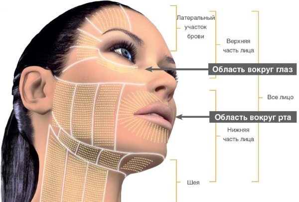 Nâng cơ SMAS - làm sạch mặt bằng sóng siêu âm. Đặc điểm của quy trình, chỉ định, chống chỉ định, hiệu quả mong đợi, ảnh