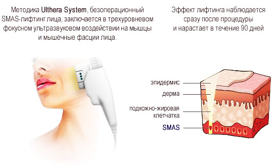 Nâng cơ SMAS - làm sạch mặt bằng sóng siêu âm. Đặc điểm của quy trình, chỉ định, chống chỉ định, hiệu quả mong đợi, ảnh