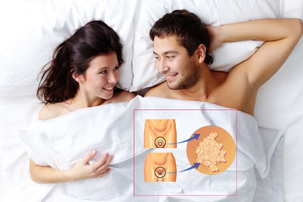 HPV ในผู้หญิง - มันคืออะไรอาการประเภทการแพร่เชื้อการรักษา human papillomavirus ทางนรีเวชวิทยา