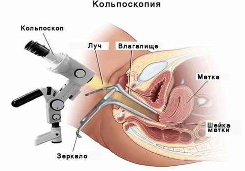HPV ในผู้หญิง - มันคืออะไรอาการประเภทการแพร่เชื้อการรักษา human papillomavirus ทางนรีเวชวิทยา