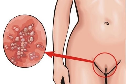 HPV ในผู้หญิง - มันคืออะไรอาการประเภทการแพร่เชื้อการรักษา human papillomavirus ทางนรีเวชวิทยา