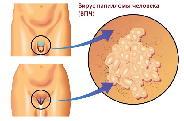 HPV ในผู้หญิง - มันคืออะไรอาการประเภทการแพร่เชื้อการรักษา human papillomavirus ทางนรีเวชวิทยา
