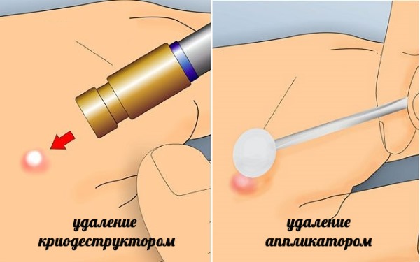 HPV ในผู้หญิง - มันคืออะไรอาการประเภทการแพร่เชื้อการรักษา human papillomavirus ทางนรีเวชวิทยา